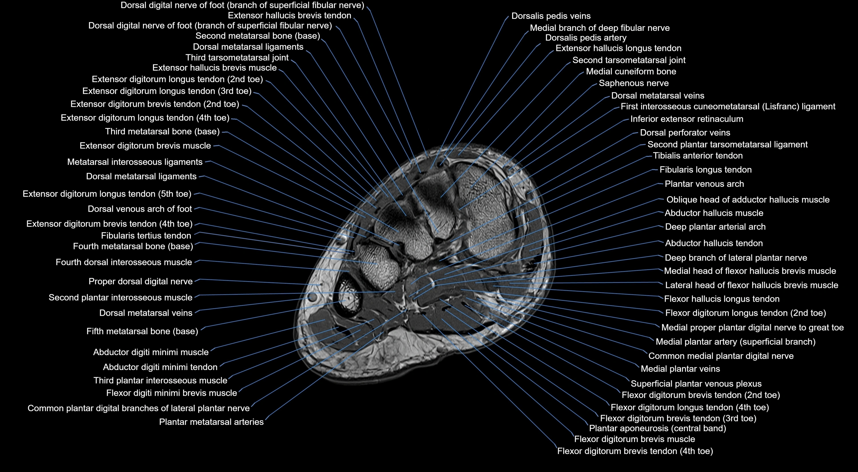 MRI mid foot coronal ligaments cross sectional anatomy 3T  radiology  image-img-00001-00016.webp
